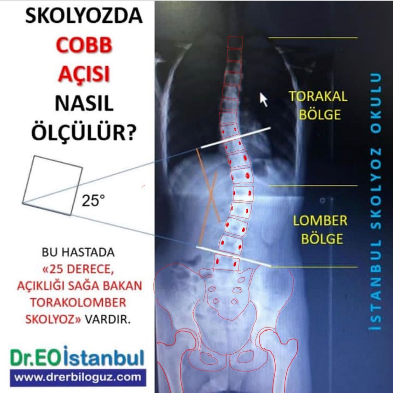 İstanbul Skolyoz Okulu